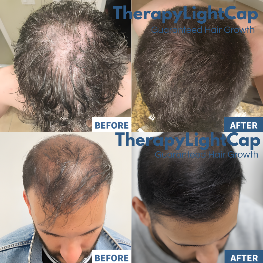 Clinically-Proven Red Light Therapy for Hair Growth